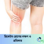 রিকেটস রোগের লক্ষণ ও প্রতিকার