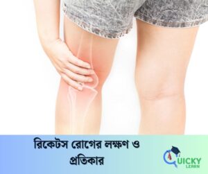 Read more about the article রিকেটস রোগের লক্ষণ ও প্রতিকার