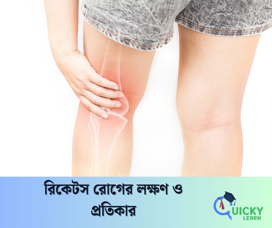 You are currently viewing রিকেটস রোগের লক্ষণ ও প্রতিকার