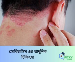 Read more about the article সোরিয়াসিস এর আধুনিক চিকিৎসা