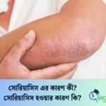 সোরিয়াসিস হওয়ার কারণ কি?