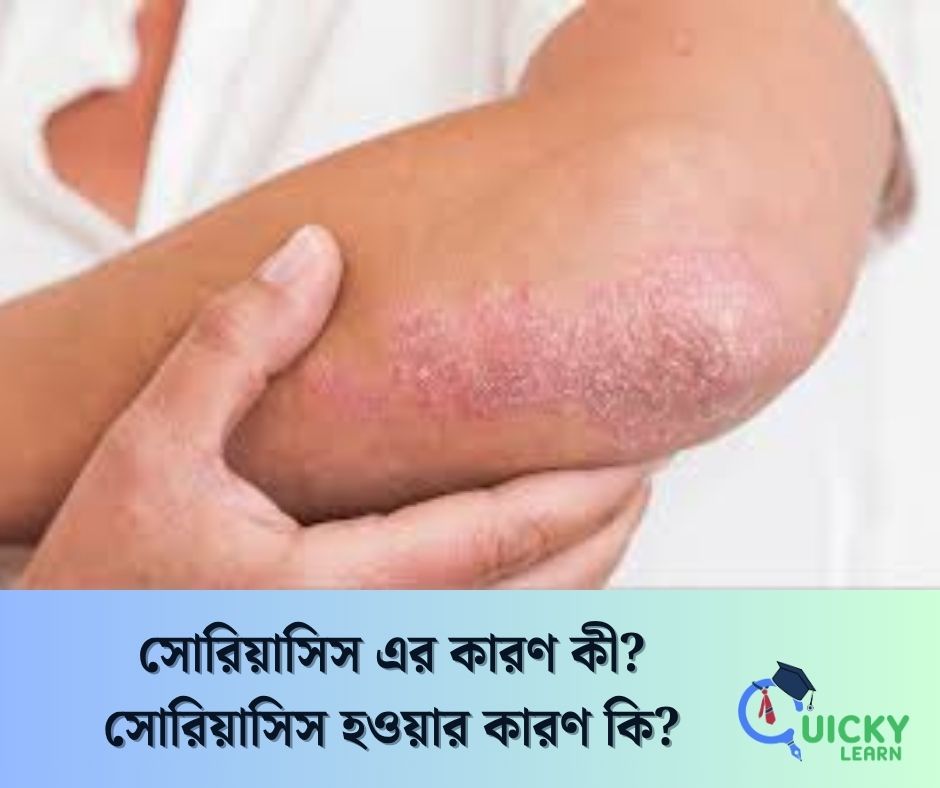 You are currently viewing সোরিয়াসিস হওয়ার কারণ কি?