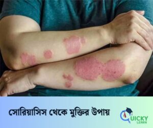 Read more about the article সোরিয়াসিস থেকে মুক্তির উপায়