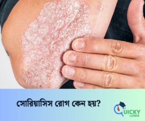 Read more about the article সোরিয়াসিস রোগ কেন হয়?