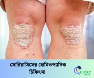 Read more about the article সোরিয়াসিসের হোমিওপ্যাথিক চিকিৎসা 