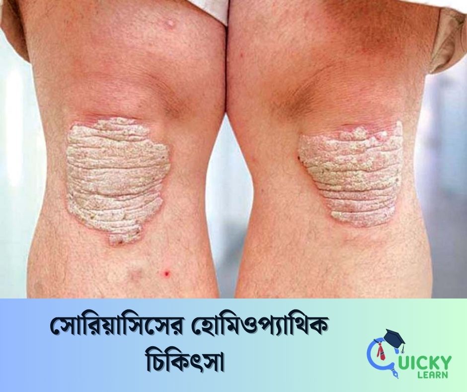 You are currently viewing সোরিয়াসিসের হোমিওপ্যাথিক চিকিৎসা 