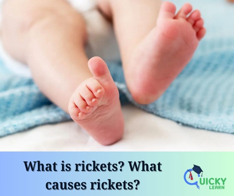 You are currently viewing What is rickets? What causes rickets?