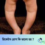 রিকেটস রোগ কি ভালো হয় ?