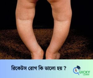 Read more about the article রিকেটস রোগ কি ভালো হয় ?